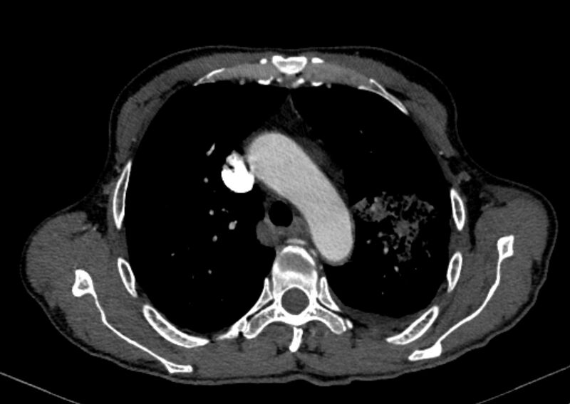File:Chronic pulmonary embolism with bubbly consolidation (Radiopaedia 91248-108850 C+ arterial phase 39).jpg
