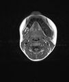Chronic reactive multifocal osteomyelitis (CRMO) - mandible (Radiopaedia 56405-63069 Axial T1 8).jpg