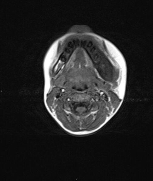 File:Chronic reactive multifocal osteomyelitis (CRMO) - mandible (Radiopaedia 56405-63069 Axial T1 8).jpg