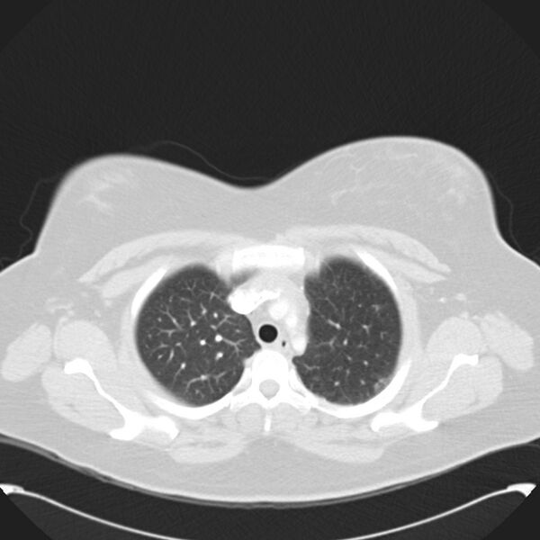 File:Chronic thromboembolic pulmonary hypertension (CTEPH) (Radiopaedia 74597-85531 Axial lung window 13).jpg