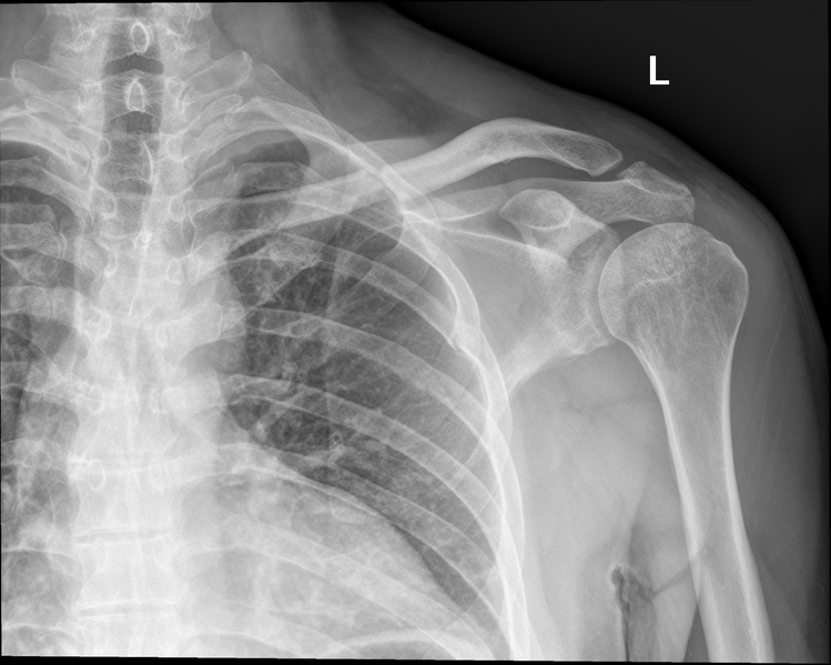 File:Clavicle and rib fractures (Radiopaedia 34975-36476 Frontal 1).png