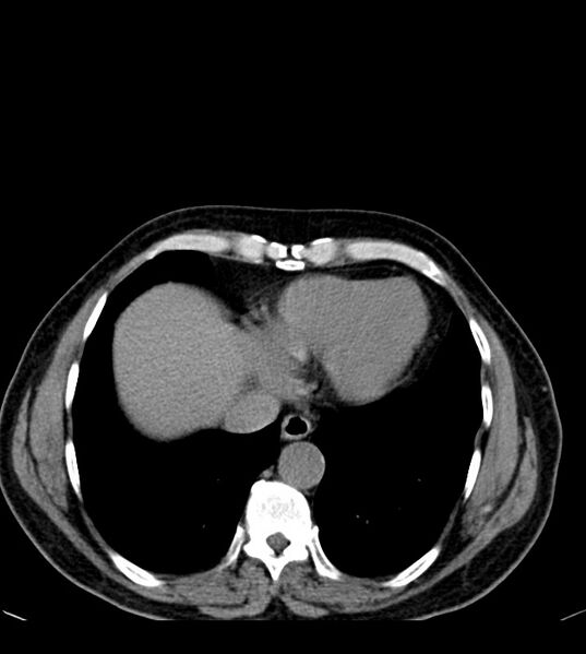 File:Clear cell renal cell carcinoma (Radiopaedia 85006-100539 Axial non-contrast 12).jpg
