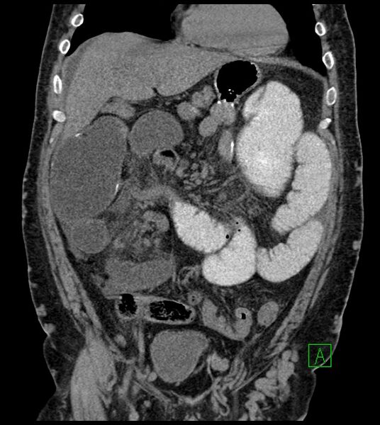 File:Closed-loop small bowel obstruction-internal hernia (Radiopaedia 78439-91096 Coronal non-contrast 39).jpg