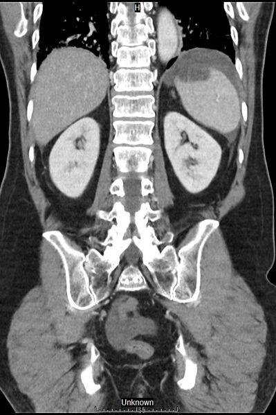 File:Closed loop bowel obstruction and ischemia (Radiopaedia 86959-103180 B 34).jpg
