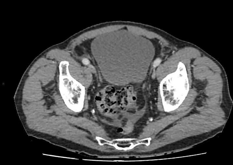 File:Closed loop small bowel obstruction with ischemia (Radiopaedia 84180-99456 A 104).jpg