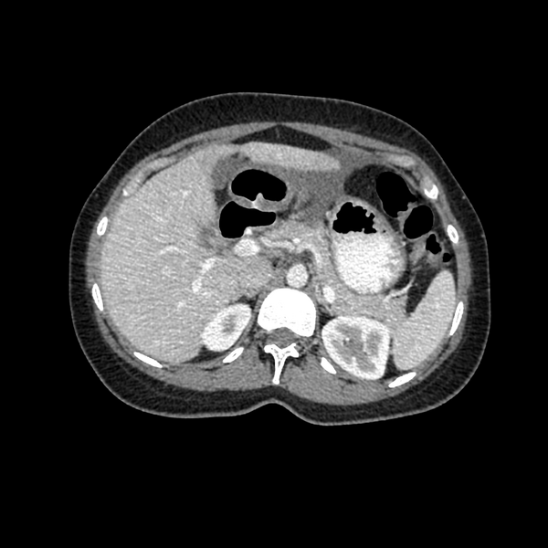 File:Cocoon abdomen with possible tubo-ovarian abscess (Radiopaedia 46235-50636 A 11).png