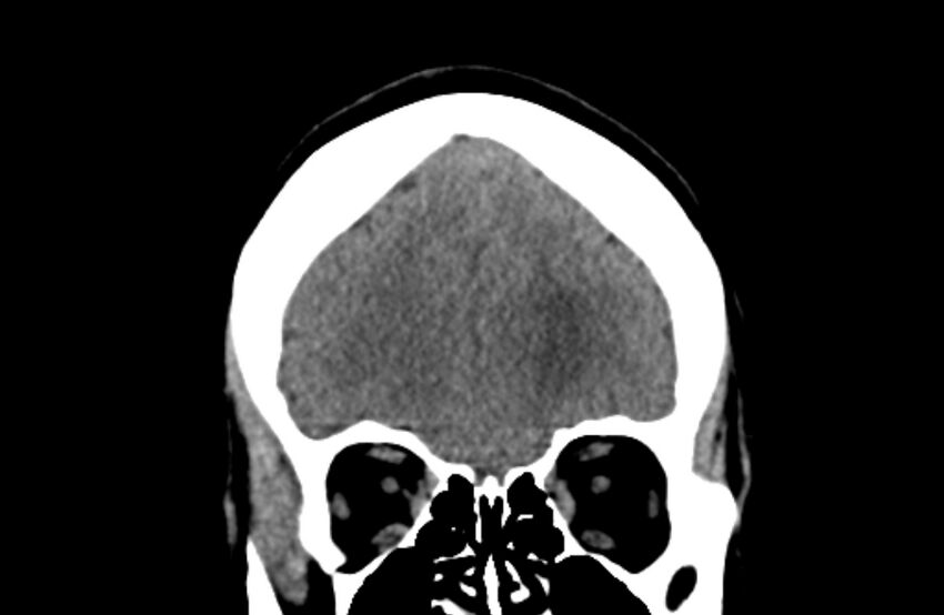 Colloid cyst (Radiopaedia 53180-59146 Coronal non-contrast 14).jpg