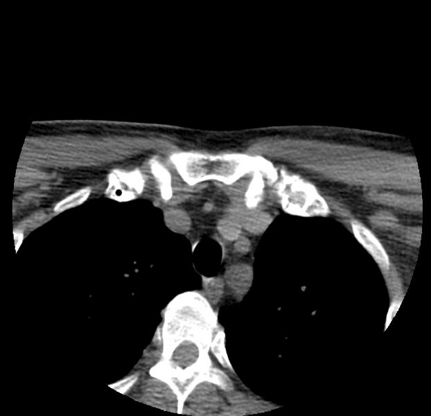 File:Colloid cyst of thyroid (Radiopaedia 22897-22923 Axial non-contrast 58).jpg