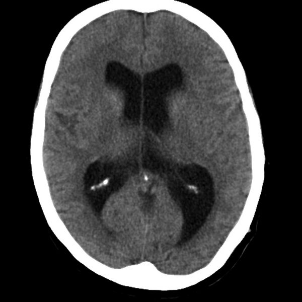 File:Colloid cyst with hydrocephalus (Radiopaedia 9373-10064 Axial non-contrast 11).jpg