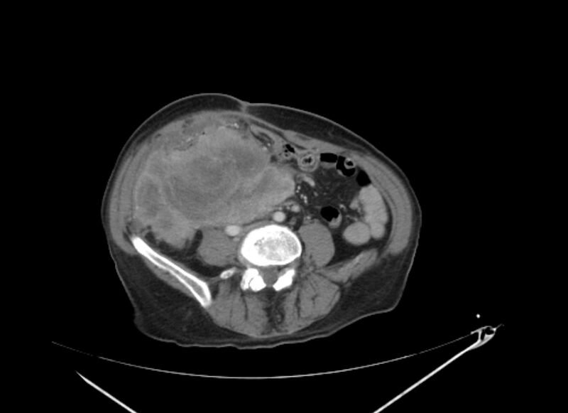 File:Colon cancer mimicking renal cell carcinoma (Radiopaedia 28986-29335 C 48).jpg