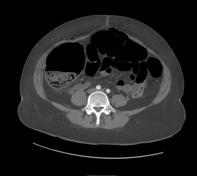 File:Colonic pseudo-obstruction (Radiopaedia 79752-92980 A 117).png