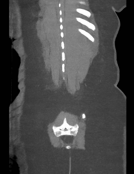 File:Colonic pseudo-obstruction (Radiopaedia 79752-92980 B 53).png
