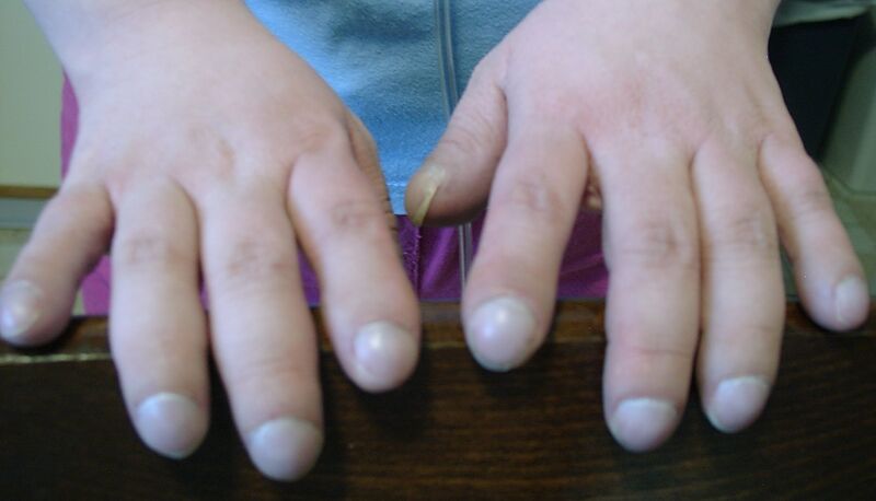 File:Finger clubbing (photo) (Radiopaedia 36251).jpg