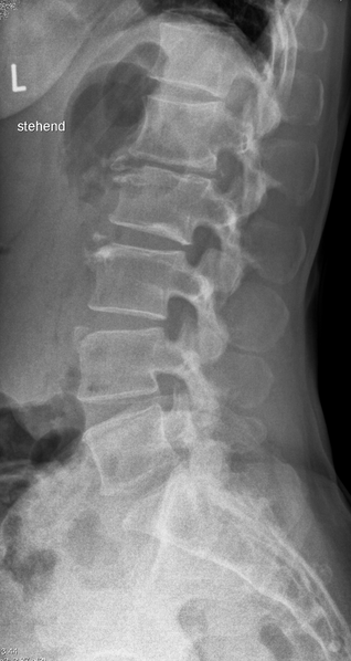 File:Limbus vertebrae (Radiopaedia 18481).png