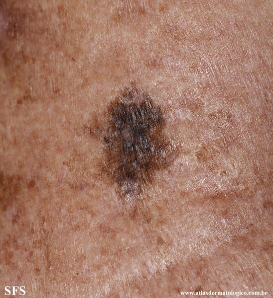 File:Melanoma (Dermatology Atlas 123).jpg