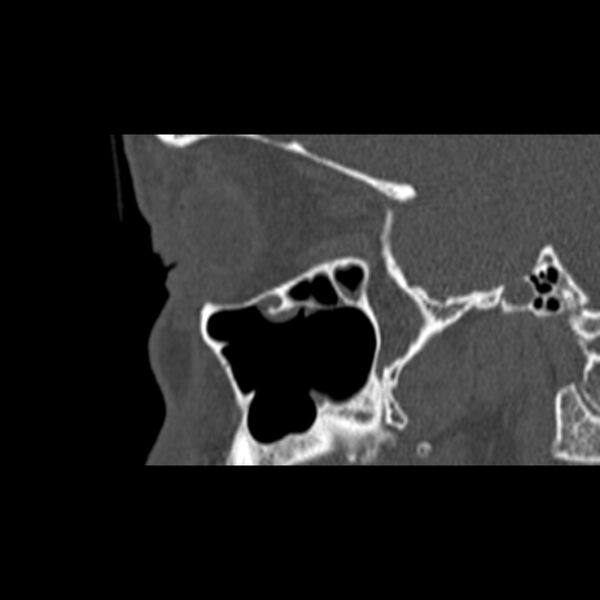 File:Nasal septal perforation (Radiopaedia 25030-25289 Sagittal bone window 55).jpg