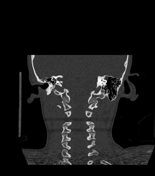 File:Nasoorbitoethmoid fracture (Radiopaedia 90044-107205 Coronal bone window 109).jpg