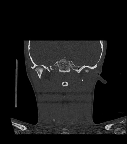 File:Nasoorbitoethmoid fracture (Radiopaedia 90044-107205 Coronal bone window 93).jpg