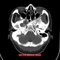 Nasopharyngeal carcinoma recurrence - skull base destruction (Radiopaedia 29107-29491 A 7).jpg