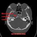 Nasopharyngeal carcinoma recurrence - skull base destruction (Radiopaedia 29107-30461 skull base 1).jpg
