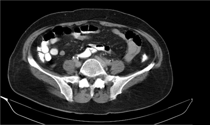 File:Necrotizing pancreatitis (Radiopaedia 20595-20495 Axial C+ delayed 31).jpg