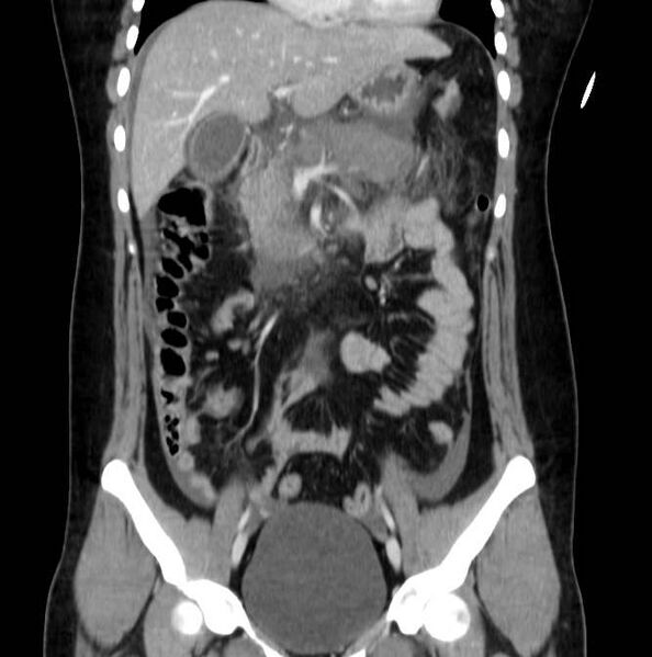 File:Necrotizing pancreatitis (Radiopaedia 23001-23031 B 28).jpg