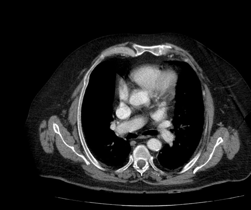 Nephroptosis with inguinal hernia containing perirenal fat (Radiopaedia 56632-63391 C 5).jpg