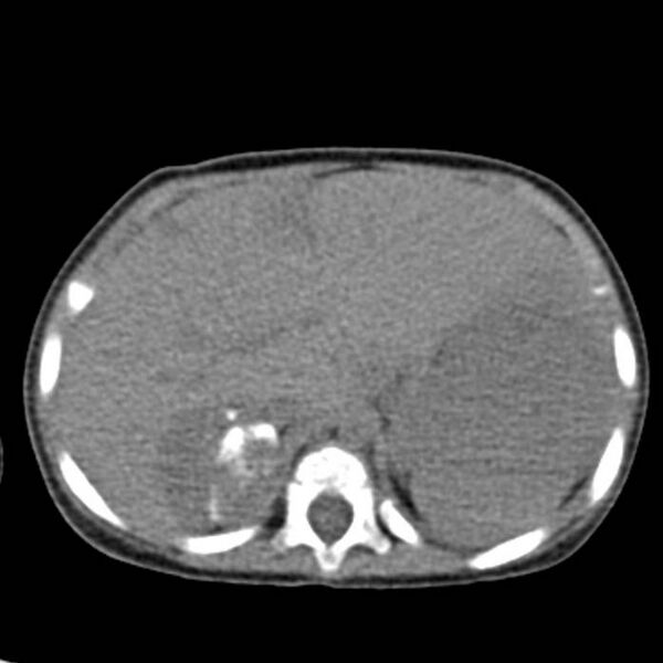 File:Neuroblastoma with skull metastases (Radiopaedia 30326-30960 Axial non-contrast 13).jpg
