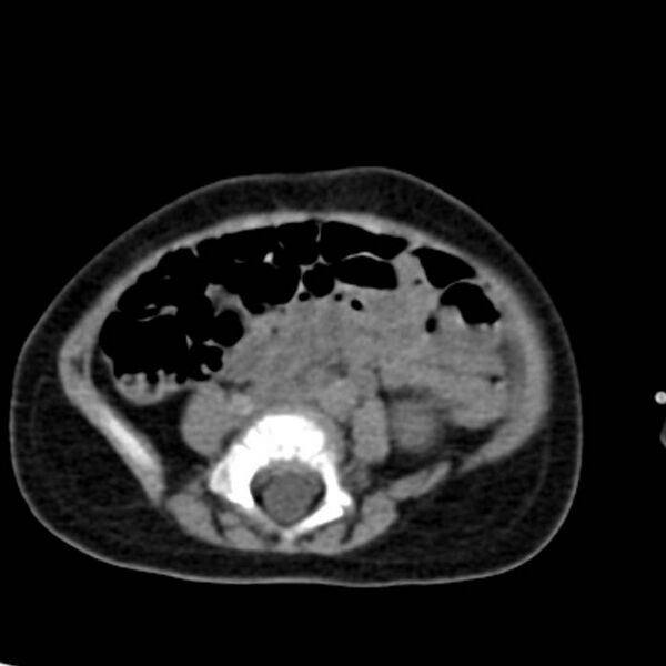 File:Neuroblastoma with skull metastases (Radiopaedia 30326-30960 Axial non-contrast 40).jpg