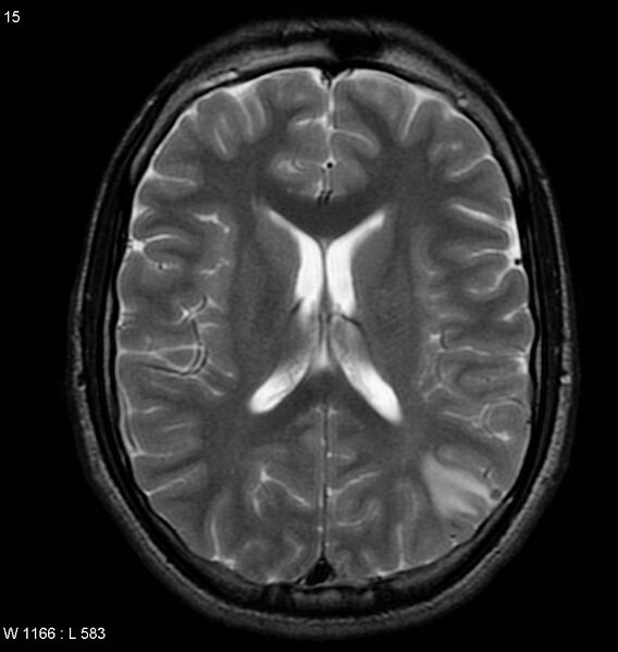 File:Neurocysticercosis (Radiopaedia 4767-6773 Axial T2 1).jpg