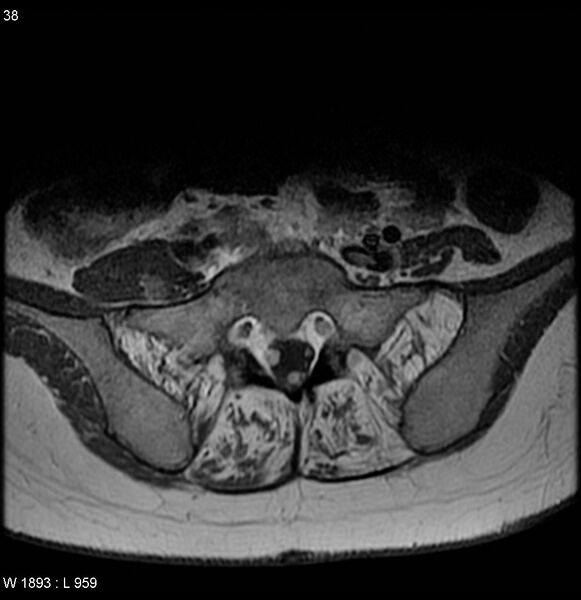 File:Neurofibromatosis type 2 - cranial and spinal involvement (Radiopaedia 5351-7112 Axial T1 C+ 37).jpg