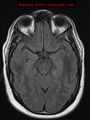 Neuroglial cyst (Radiopaedia 10713-11184 Axial FLAIR 14).jpg