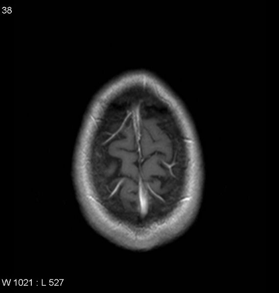 File:Neurosarcoidosis (Radiopaedia 10930-11351 Axial T1 C+ 19).jpg