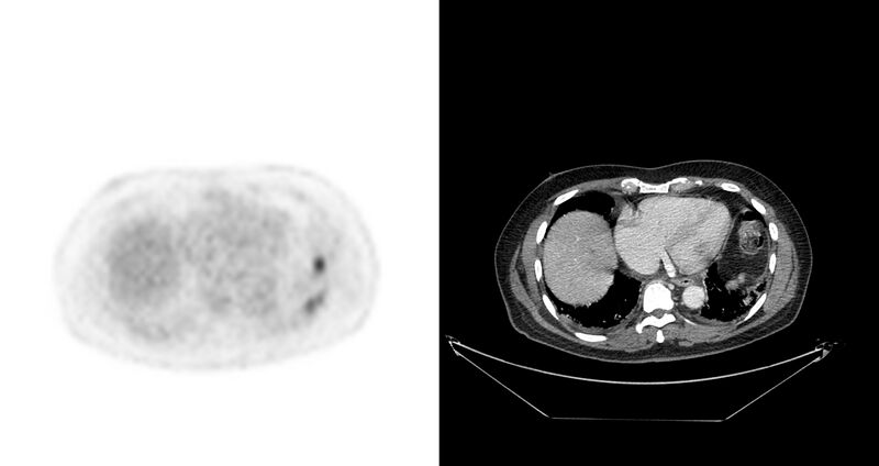 File:Non-Hodgkin lymphoma involving seminal vesicles with development of interstitial pneumonitis during Rituximab therapy (Radiopaedia 32703-33675 axial PET CT 42).jpg