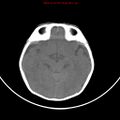 Non-accidental injury - bilateral subdural with acute blood (Radiopaedia 10236-10765 Axial non-contrast 9).jpg