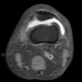 Non-displaced patella fracture (Radiopaedia 15932-15582 Axial PD fat sat 4).jpg
