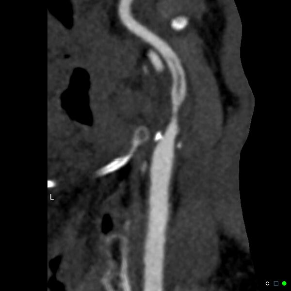 File:Non-occlusive intraluminal internal carotid artery thrombus (Radiopaedia 37751-39658 A 44).jpg