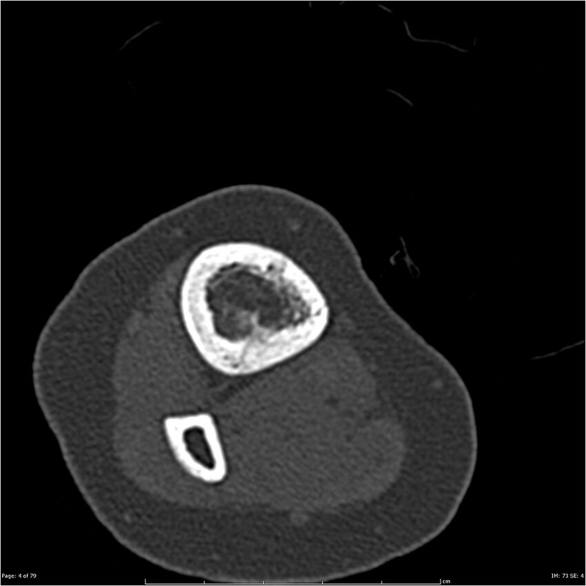 Non-ossifying fibroma (Radiopaedia 23651-23780 bone window 4).jpg