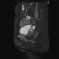 Non-puerperal uterine inversion (Radiopaedia 78343-90983 Sagittal T2 fat sat 21).jpg
