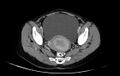Non-puerperal uterine inversion (Radiopaedia 78343-91094 A 27).jpg