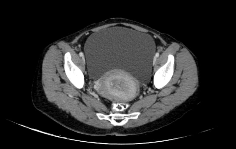File:Non-puerperal uterine inversion (Radiopaedia 78343-91094 A 27).jpg