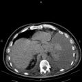 Non Hodgkin lymphoma in a patient with ankylosing spondylitis (Radiopaedia 84323-99621 Axial non-contrast 25).jpg