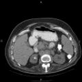 Non Hodgkin lymphoma in a patient with ankylosing spondylitis (Radiopaedia 84323-99624 Axial non-contrast 37).jpg