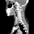 Normal CT of the neck (Radiopaedia 14575-14500 Sagittal C+ 22).jpg