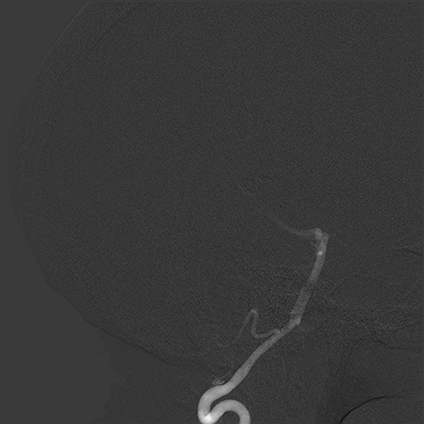 File:Normal cerebral angiogram (four vessel DSA) (Radiopaedia 41708-44649 L 6).png