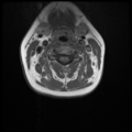 Normal cervical and thoracic spine MRI (Radiopaedia 35630-37156 Axial T1 21).png