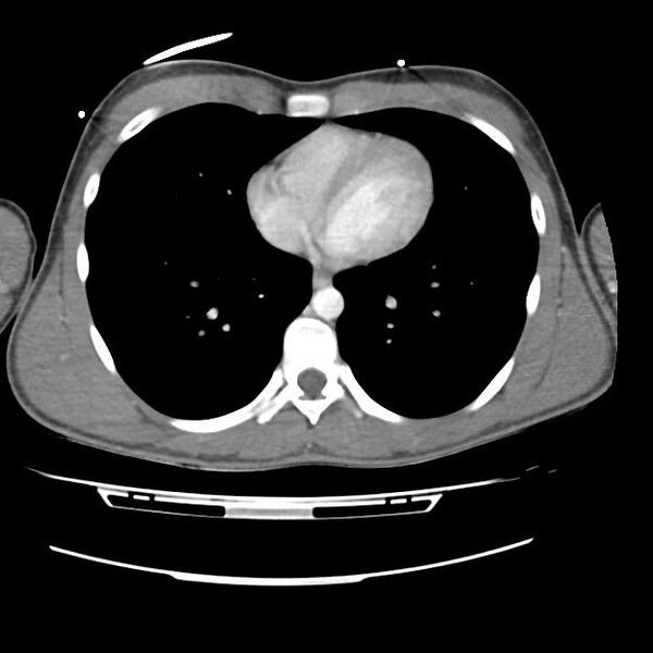 File:Normal dual-phase trauma CT chest,abdomen and pelvis (Radiopaedia 48092-52899 A 36).jpg