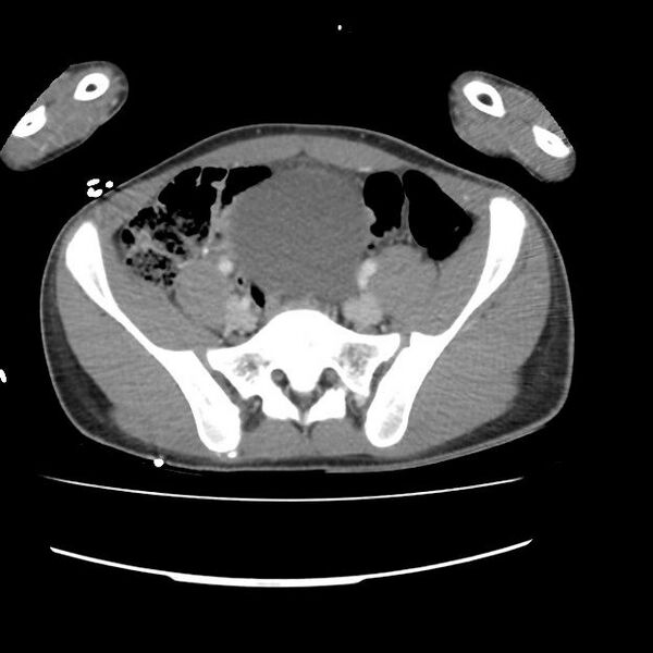 File:Normal dual-phase trauma CT chest,abdomen and pelvis (Radiopaedia 48092-52899 A 92).jpg