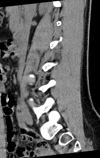 File:Normal lumbar spine CT (Radiopaedia 46533-50986 C 68).png