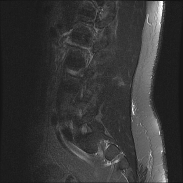 File:Normal lumbar spine MRI (Radiopaedia 43051-46311 Sagittal STIR 5).jpg